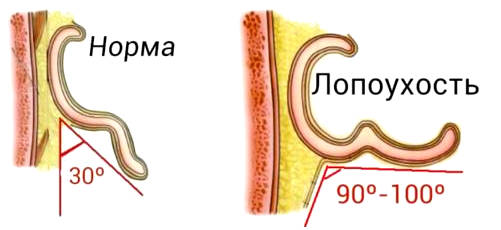 Норма лопоухости