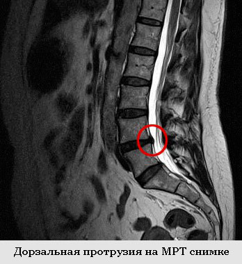 дорзальная протрузия на МРТ снимке
