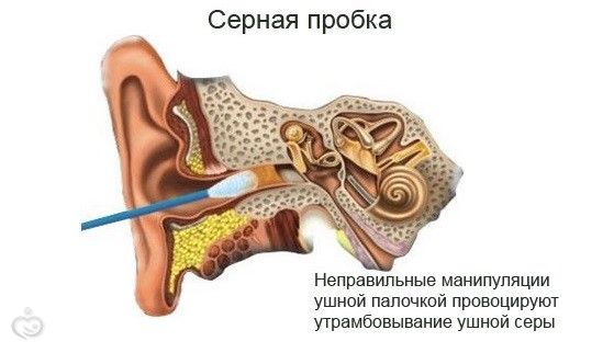 «Как разложить уши», или Как избавиться от заложенности ушей