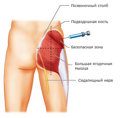 Как правильно делать уколы в ягодицу, попу внутримышечно ребенку, себе. Куда, как поставить, колоть