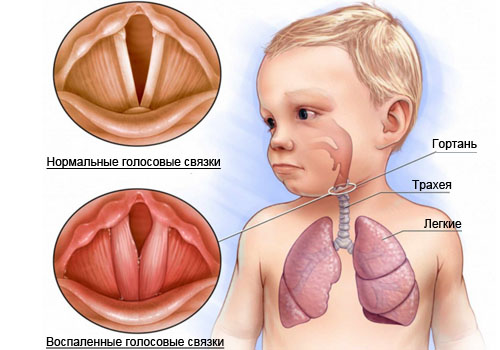 ларингит у ребёнка схема